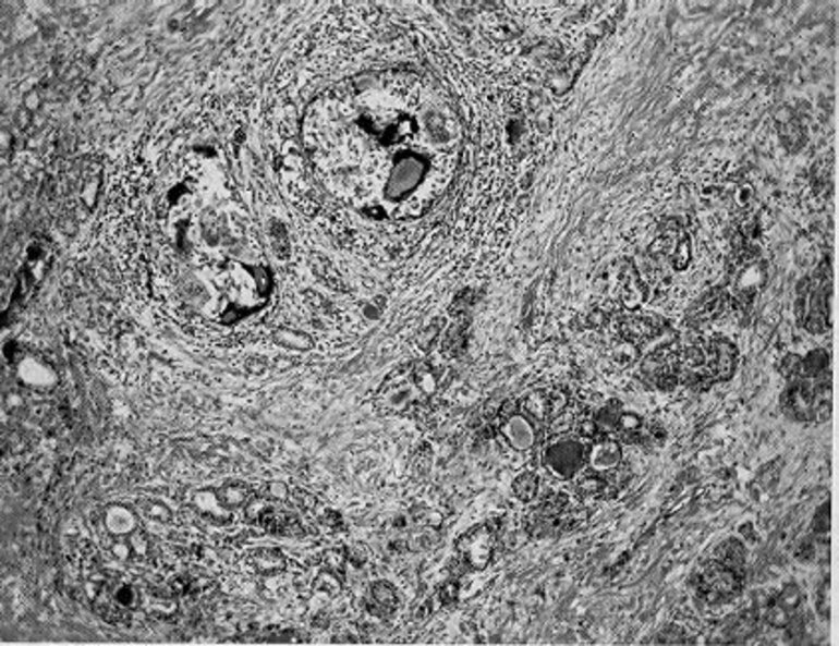 Figure 1. . Subacute thyroiditis.