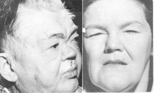 Figure 9-3. (A) The classic torpid facies of severe myxedema in a man.