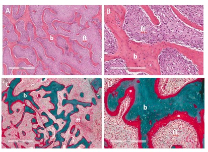 polyostotic fibrous dysplasia histology