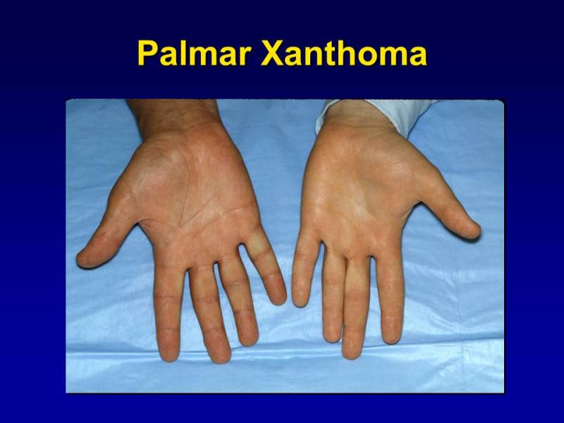Xanthomas Hands