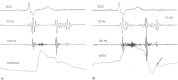 Figure 24.1. Four-channel phonocardiogram taken at a paper speed of 100 mm/sec.