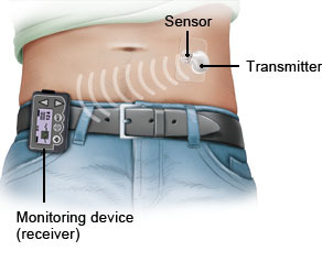 Illustration: CGM system: Continuous glucose monitoring in subcutaneous tissue