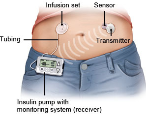 Illustration: CGM system with an insulin pump