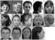 Figure 1. . Craniofacial phenotype in individuals with a TXNL4A-related craniofacial disorder.