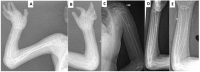 Figure 6. . Radiographs of the long bones of the upper extremities in affected individuals at ages 6 years (A, B) and 13 years (C, D, E).