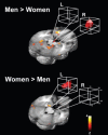 FIGURE 15.2. Sex-related hemispheric lateralization of amygdala function in long-term memory for emotionally arousing films.