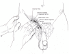 Figure 80.15. Direct compression of the inguinal region to determine site of herniation.