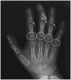 Figure 2. [Broad terminal phalanges (A) and broad, radially deviated thumbs  (B)]. - GeneReviews® - NCBI Bookshelf