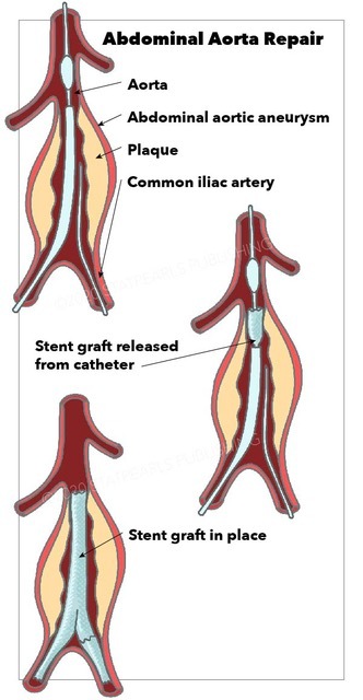 Image Abdominal_Aorta_Repair-01