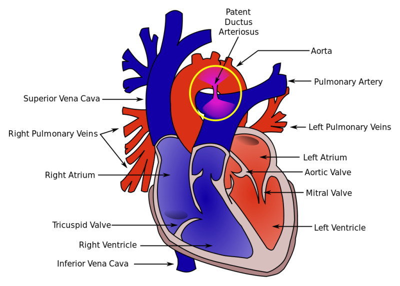 Figure, Heart cross section with Patent Ductus Arteriosus. Contributed by  Wikimedia Commons (Public Domain)] - StatPearls - NCBI Bookshelf