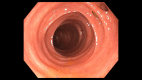 Diverticulosis on colonoscopy