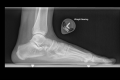 Single lateral radiograph of the left foot demonstrates pes planus as evidenced by a decreased calcaneal inclination angle
