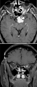 Optic Nerve Sheath Meningioma