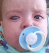 Example of buphthalmos of the right eye in an infant