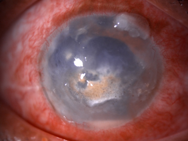 Slit-lamp image of the patient of recurrent anterior uveitis depicting circumciliary congestion, corneal scarring, central band shaped keratopathy, hypopyon in anterior chamber and pseudophakia Contributed by Dr