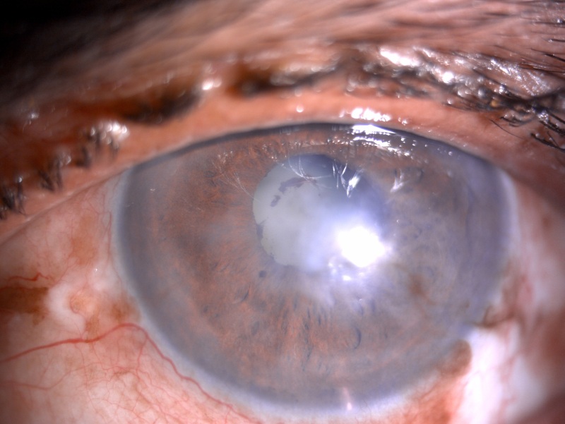 Slit- lamp image of the patient with recurrent uveitis depicting mild circumciliary congestion, nebular corneal scarring, few areas of iris atrophy along with a complicated cataract Contributed by Dr
