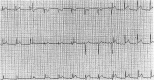 Acute pericarditis ECG