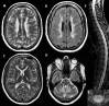 Figure 1. . T2-weighted (A, C, D) and FLAIR (B) axial images of the brain in an adult with LBSL show extensive, patchy abnormalities with increased signal in the periventricular and deep cerebral white matter and posterior limb of the internal capsule.