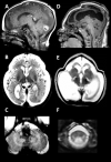 Figure 3. . The MRI in a severe, early-onset form of LBSL at age two days (A, B, C) and age five months (D, E, F) shows striking progression of abnormalities.