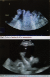 Paracentesis - Wikipedia