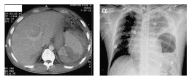 CT scan of a grade IV-V splenic injury