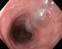 esophageal bleeding cirrhosis