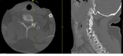 CT Scan of C6-C7 Fracture