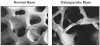 Figure 2-5. Normal vs. Osteoporotic Bone.