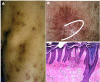 Figure 1 PRURIGO NODULARIS involving the limbs of a 65-year old lady: A, Clinical Image showing the typical hyperpigmented papules and nodules over the right upper extremity with excoriations; B, Polarized dermoscopic image from a papule showing an irregularly-shaped large reddish-brown clod with localized white structureless area (white arc), with interspersed red and brown colored dots and pigmented granules [Escope, USB Videodermoscope, 30X; Timpac Healthcare Pvt