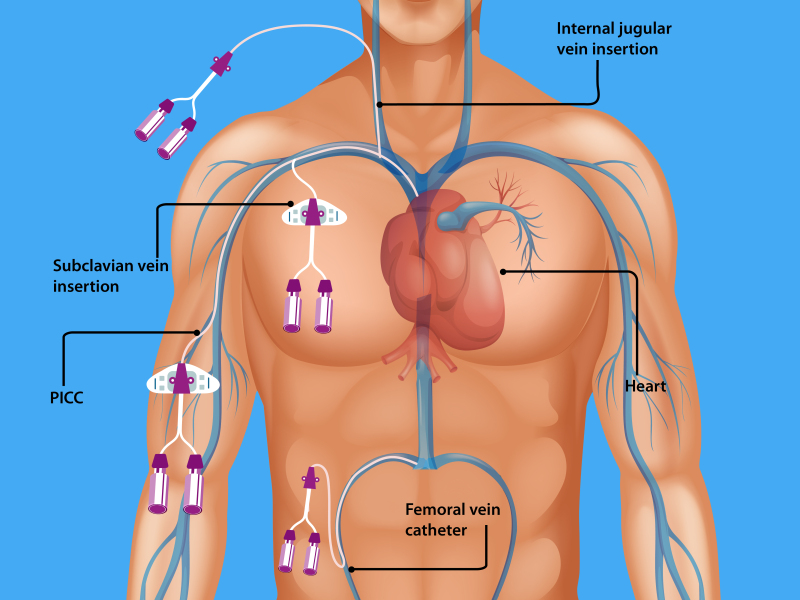 central venous catheter subclavian