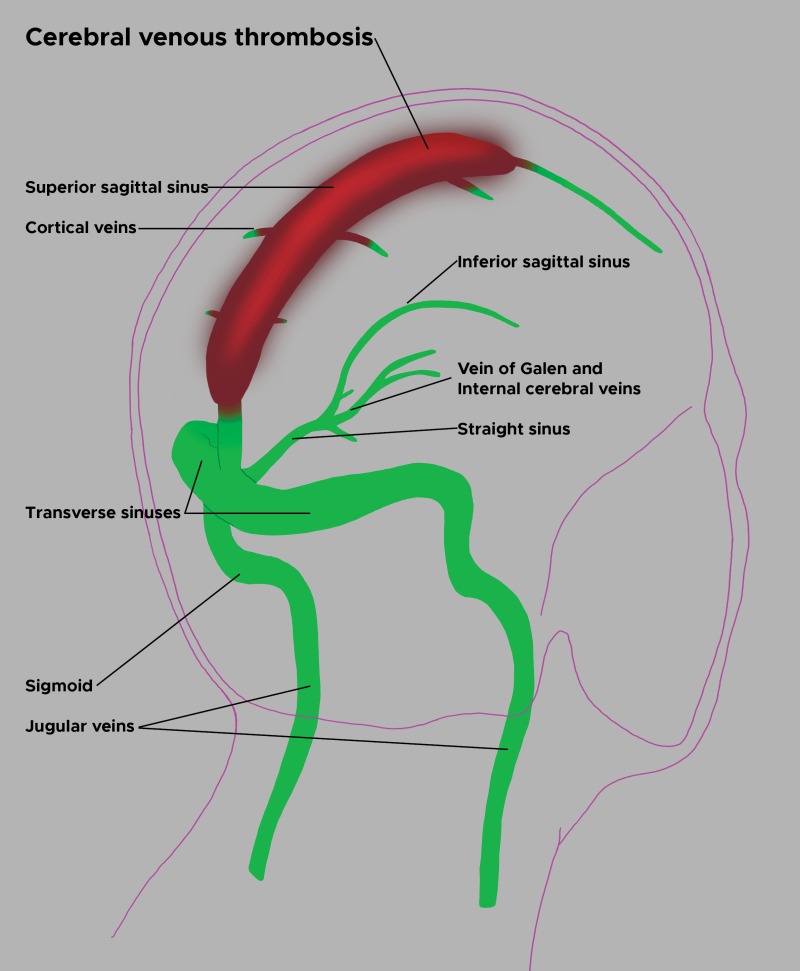 superior sagittal sinus thrombosis