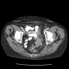 Complicated diverticulitis with abscess Contributed by Dr