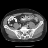 Uncomplicated diverticulitis on CT scan Contributed by Dr
