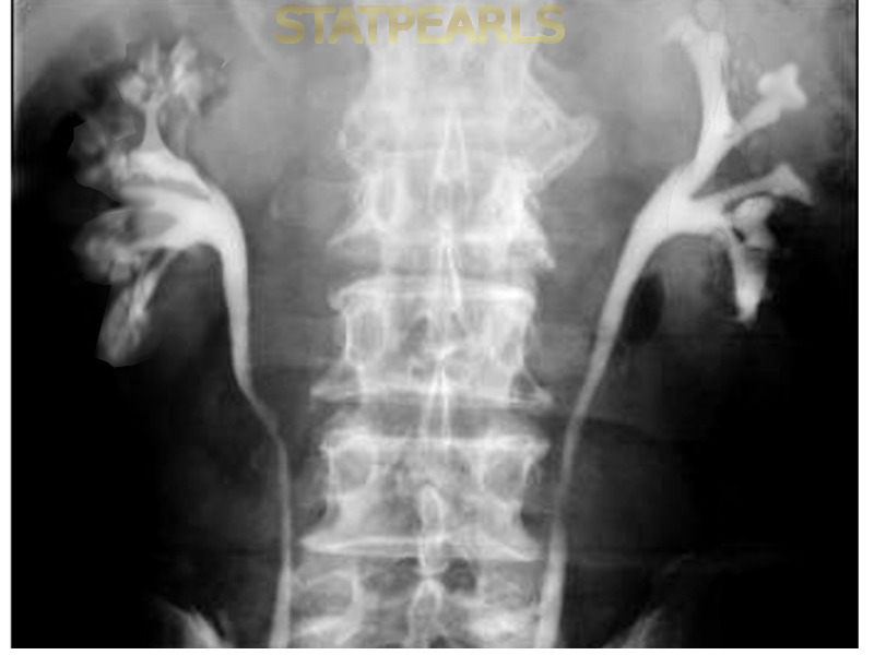 medullary sponge kidney