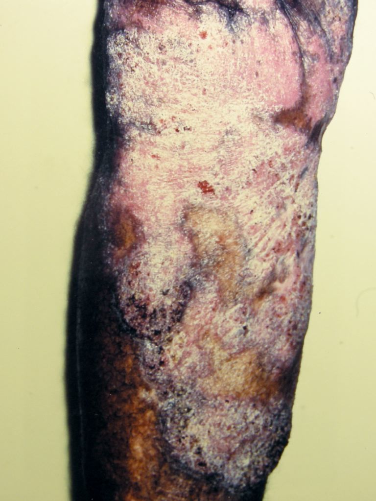 Image chromoblastomycosis