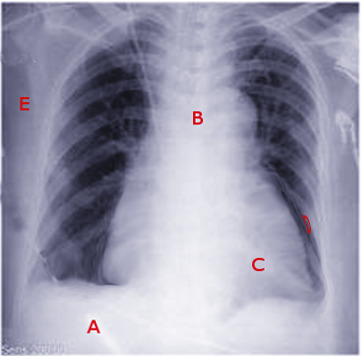 Central Line Placement - StatPearls - NCBI Bookshelf