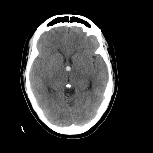 Figure Head Ct Colloid Cyst Foramen Of Monroe Contributed By Scott Dulebohn Md Statpearls 4882