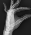 Boutonniere deformity of the 5th digit