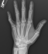 Boutonniere deformity of the 5th digit