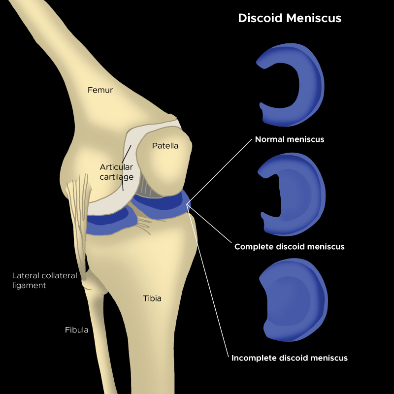 Discoid Meniscus Statpearls Ncbi Bookshelf