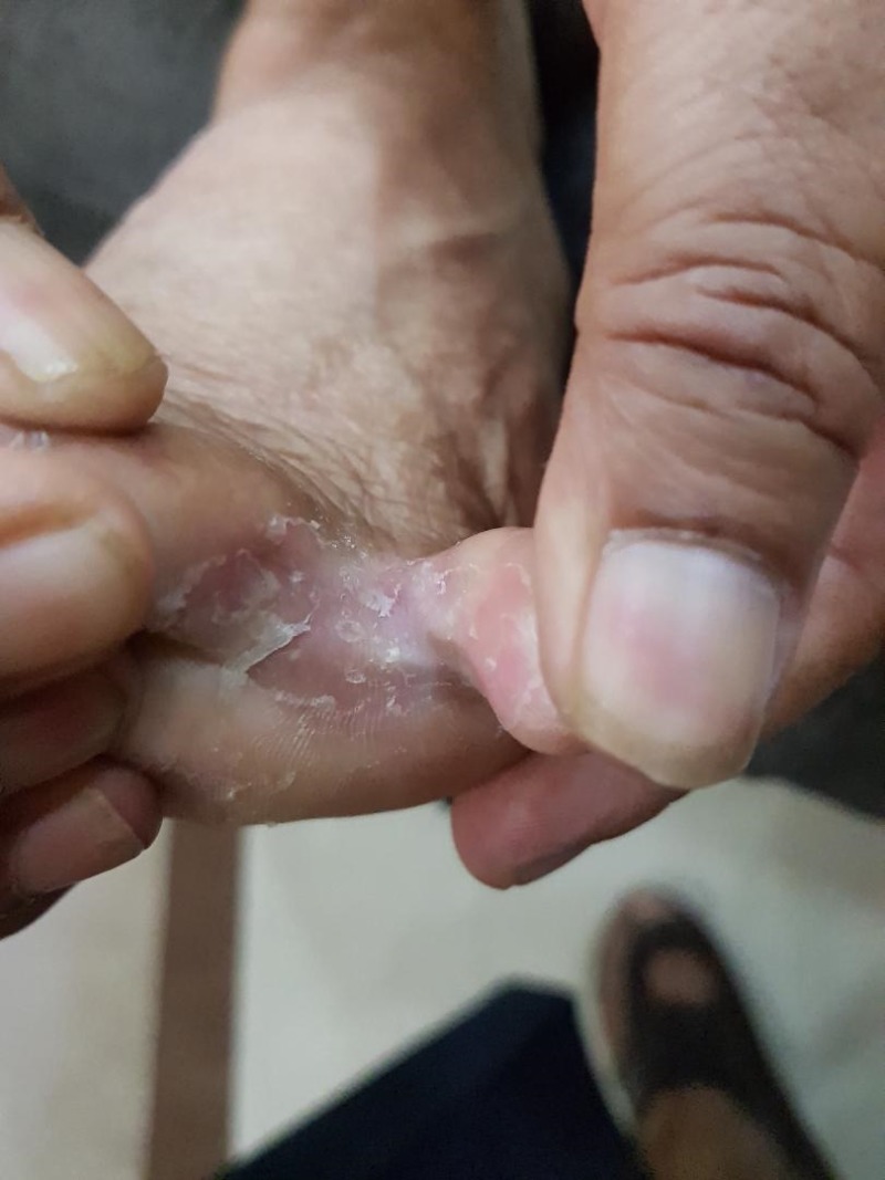 Figure Tinea Pedis Contributed By Pramod Kumar Nigam Statpearls