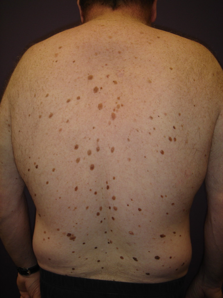 acquired melanocytic nevus