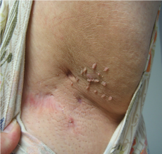 Abdominal wall skin lesions in adult morbid obese women