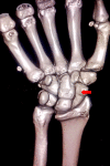 PT flashcards on X: THE WRIST AND HAND: ANATOMICAL SNUFFBOX 💡 ◦The  “anatomic snuffbox” is an important area. It is a skin depression that lies  distal to the styloid process of the