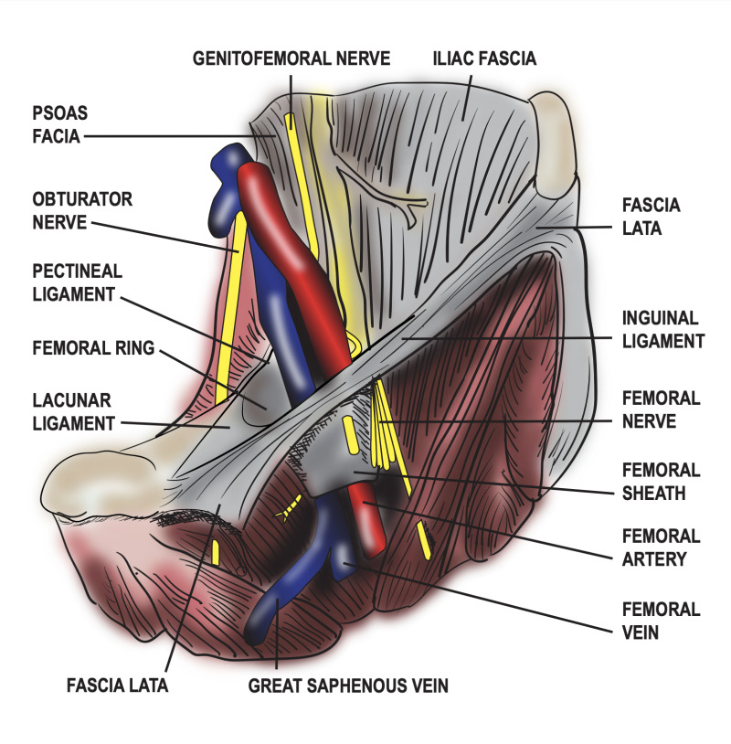 [Figure, Diagram of the femoral sheath and its contents. Contributed by ...