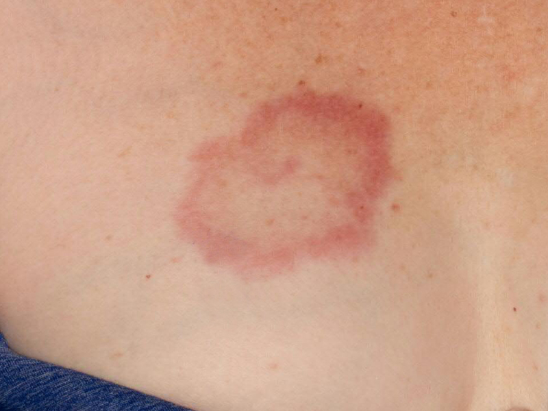 butterfly rash on chest