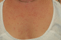 Tumid lupus erythematosus of the upper chest Contributed by Drs