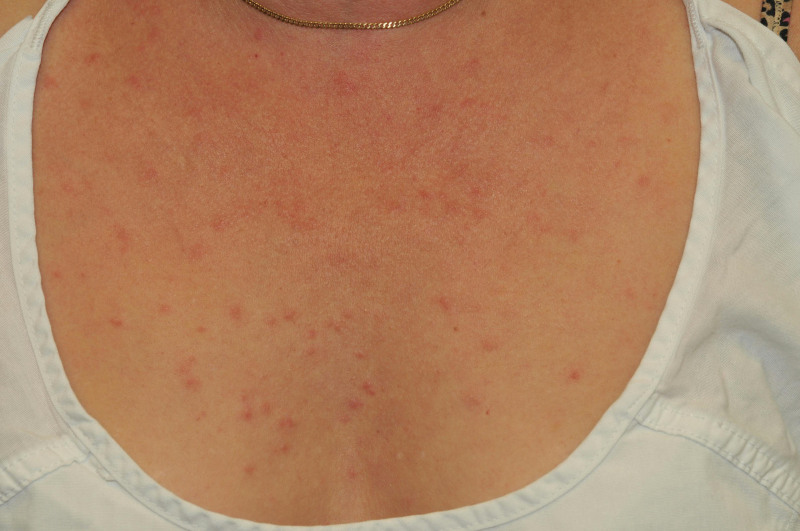 butterfly rash on chest
