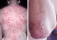 Fig 2: Rash of dermatitis herpetiformis