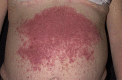 Dermatitis herpetiformis Contributed by Wikimedia User: MadHero88 ( CC BY-SA 3